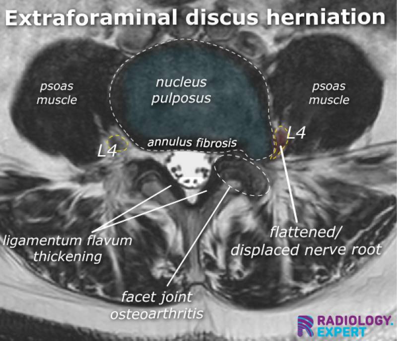 mri-lumbar-spine